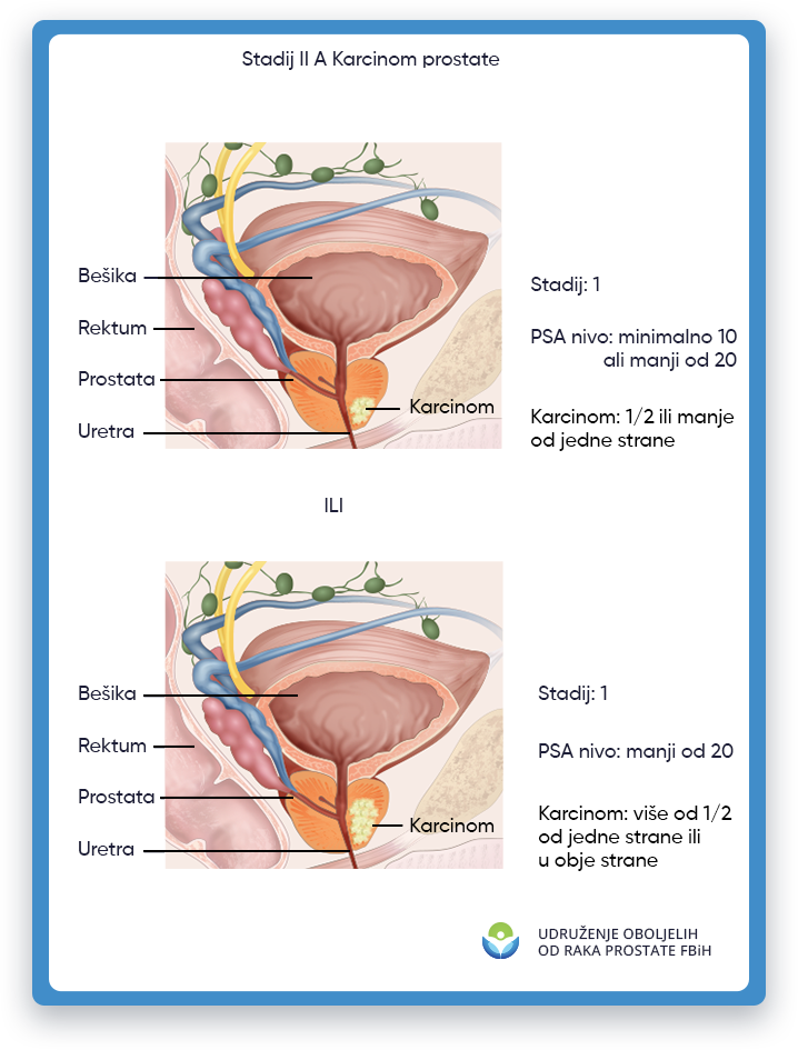 Prikazana je ilustracija koja prikazuje rak prostate stadijuma 2A, s fokusom na područje muškog tijela
                 gde se nalazi prostata, kao i bešika, rektum i uretra. U stadijumu 2A raka prostate,
                 tumor je izrastao izvan prostate, ali se nije proširio na udaljene dijelove tijela.
                 Ova ilustracija ima za cilj da pruži vizuelni prikaz raka prostate stadijuma 2A
                 obrazovne svrhe i pomoći u razumijevanju lokacije i potencijalnog utjecaja tumora kod muškaraca
                 tijelo.