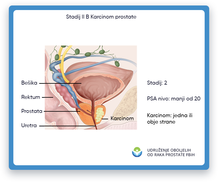 Prikazana je ilustracija koja prikazuje rak prostate stadijuma 2B, s fokusom na područje muškog tijela
                 gde se nalazi prostata, kao i bešika, rektum i uretra. U stadijumu 2B raka prostate,
                 tumor je izrastao izvan prostate i mogao se proširiti na obližnja tkiva ili organe, kao što je
                 sjemenih mjehurića. Ova ilustracija ima za cilj da pruži vizuelni prikaz raka prostate stadijuma 2B
                 obrazovne svrhe i pomoći u razumijevanju lokacije i potencijalnog utjecaja tumora kod muškaraca
                 tijelo.