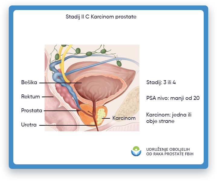 Prikazana je ilustracija koja prikazuje rak prostate stadijuma 2C, s fokusom na područje muškog tijela
                 gde se nalazi prostata, kao i bešika, rektum i uretra. U stadijumu 2B raka prostate,
                 tumor je izrastao izvan prostate i mogao se proširiti na obližnja tkiva ili organe, kao što je
                 sjemenih mjehurića. Ova ilustracija ima za cilj da pruži vizuelni prikaz raka prostate stadijuma 2B
                 obrazovne svrhe i pomoći u razumijevanju lokacije i potencijalnog utjecaja tumora kod muškaraca
                 tijelo.