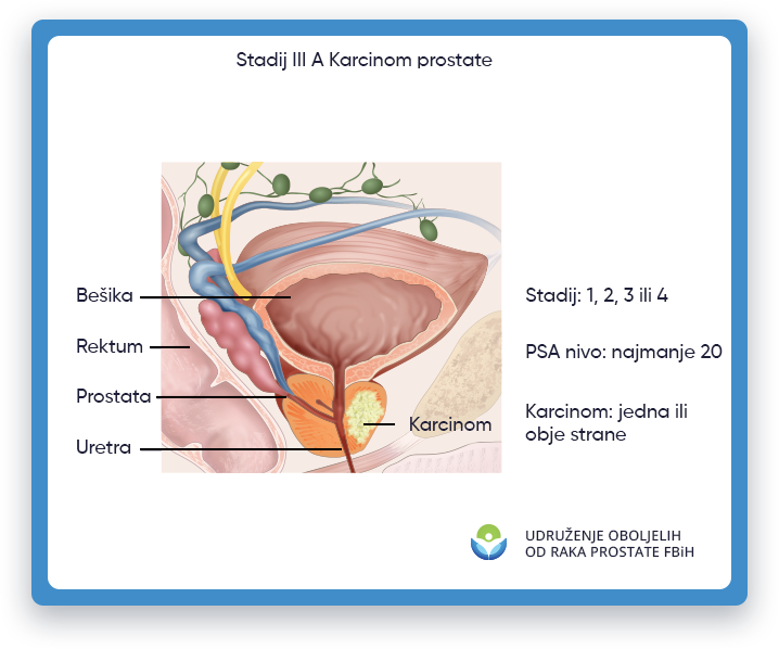 Prikazana je ilustracija koja prikazuje rak prostate stadijuma 3A, s fokusom na područje muškog tijela
                 gde se nalazi prostata, kao i bešika, rektum i uretra. U stadijumu 2B raka prostate,
                 tumor je izrastao izvan prostate i mogao se proširiti na obližnja tkiva ili organe, kao što je
                 sjemenih mjehurića. Ova ilustracija ima za cilj da pruži vizuelni prikaz raka prostate stadijuma 2B
                 obrazovne svrhe i pomoći u razumijevanju lokacije i potencijalnog utjecaja tumora kod muškaraca
                 tijelo.
