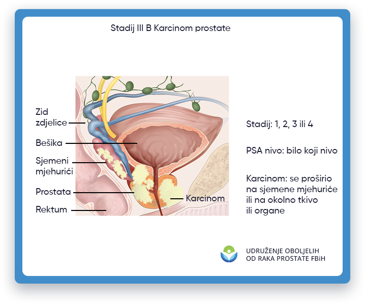 Prikazana je ilustracija koja prikazuje rak prostate stadijuma 3B, s fokusom na područje muškog tijela
                 gde se nalazi prostata, kao i bešika, rektum i uretra. U stadijumu 2B raka prostate,
                 tumor je izrastao izvan prostate i mogao se proširiti na obližnja tkiva ili organe, kao što je
                 sjemenih mjehurića. Ova ilustracija ima za cilj da pruži vizuelni prikaz raka prostate stadijuma 2B
                 obrazovne svrhe i pomoći u razumijevanju lokacije i potencijalnog utjecaja tumora kod muškaraca
                 tijelo.