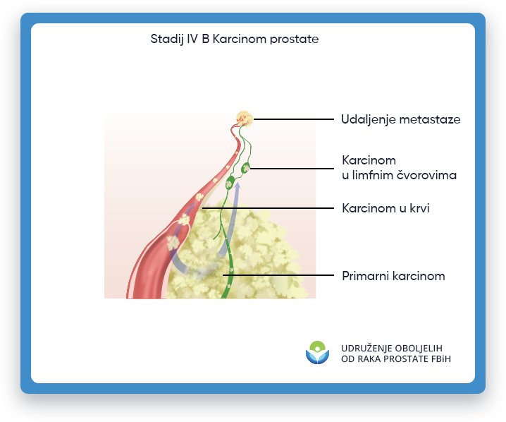 Prikazana je ilustracija koja prikazuje rak prostate stadijuma 4B, s fokusom na područje muškog tijela
                 gde se nalazi prostata, kao i udaljeni limfni čvorovi. U stadijumu 4B raka prostate,
                 tumor se proširio na druge dijelove tijela, kao što su kosti, jetra ili pluća. Ilustracija takođe
                 uključuje vizualni prikaz metastaza, koji prikazuje ćelije raka koje se šire od prostate do drugih
                 delova tela. Ova ilustracija ima za cilj da pruži vizuelni prikaz raka prostate stadijuma 4B
                 u obrazovne svrhe i da pomogne u razumijevanju obima i potencijalnog utjecaja tumora unutar
                 muško tijelo.