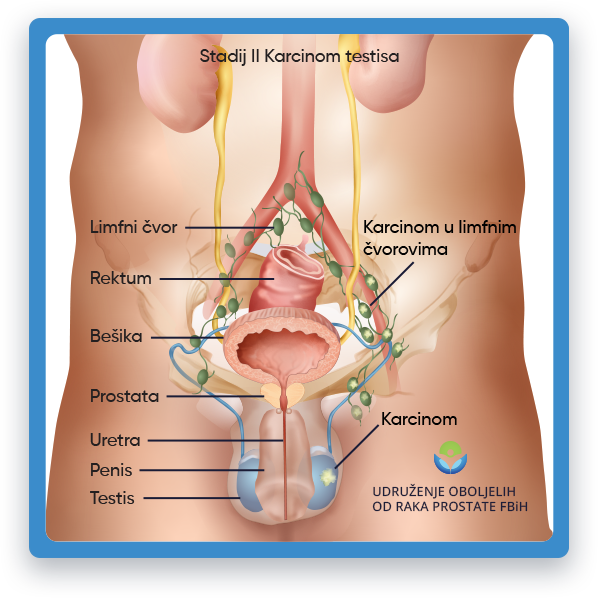 Prikazana je ilustracija muške anatomije, sa naglaskom na karlični dio gdje se nalaze testisi te 
				 ilustracija Stadija dva karcinoma testisa kod kojeg se karcinom proširio i u lokalne limfne čvorove.
				 Ova ilustracija ima za cilj da pruži vizuelni prikaz raka testisa stadija dva u obrazovne svrhe 
				 i pomoći u razumijevanju lokacije i potencijalnog utjecaja tumora kod muškaraca na tijelo